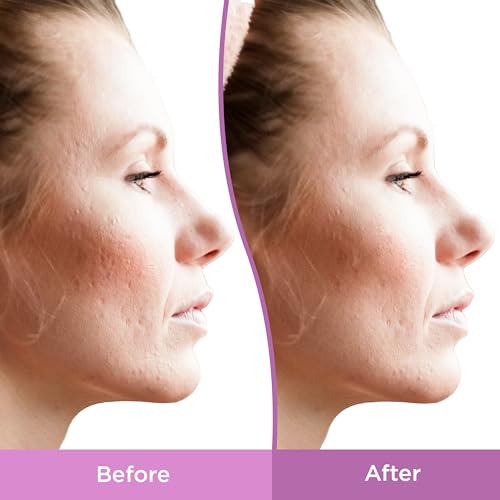 Differin Resurfacing Acne Scar Gel for Face - Hydrates & Fights Uneven Skin
