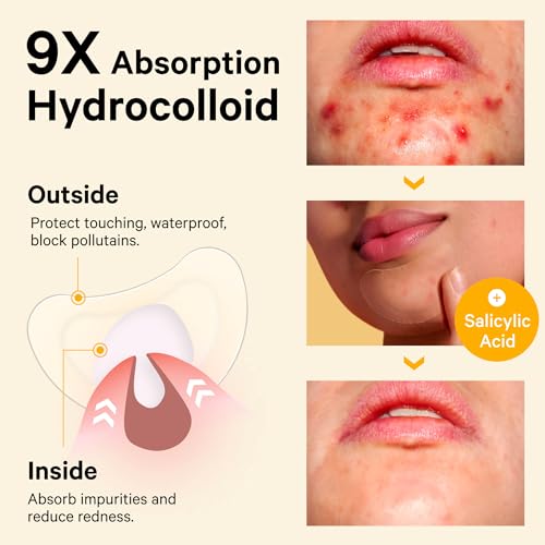 Sosky Large Chin Pimple Patches 12 Count Hydrocolloid Acne Spot Cover for Breakouts