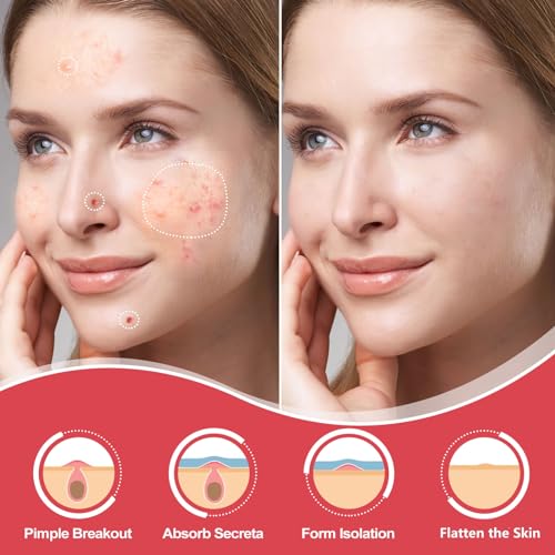 Hydrocolloid Acne Patches for Spot Treatment - 432 Count