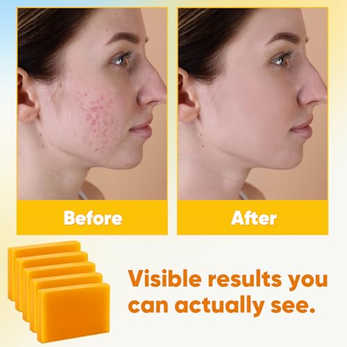 Treeroot Kojic Acid & Turmeric Soap Bar - 5 Pack for Face & Body
