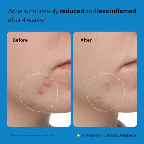 Peach Slices Acne Exfoliating Toner - 2% Salicylic Acid, 4.05 oz