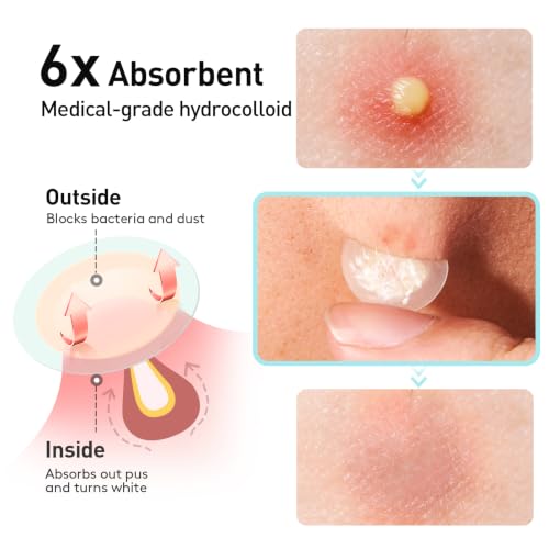 TKTK 12mm Invisible Acne Patch with Salicylic Acid - 96 Count