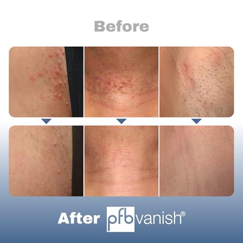 PFB Vanish Razor Bump Stopper & After Shave Serum (3.28 oz) - Soothing Solution, Relieves & Softens Skin, All Gender, Full Body Ingrown Hair Treatment with AHA & BHA, Dark Spots & Ingrown Hair Roller