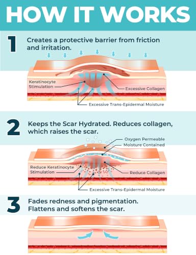 Medical Silicone Scar Sheets - 6 Reusable Strips for C-Section & Keloid Scars