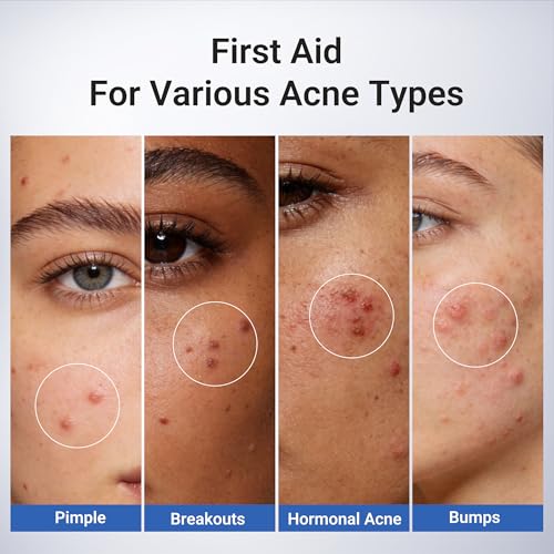 Dr.Leo 1.8% Salicylic Acid Acne Spot Treatment Drying Lotion, 0.34oz