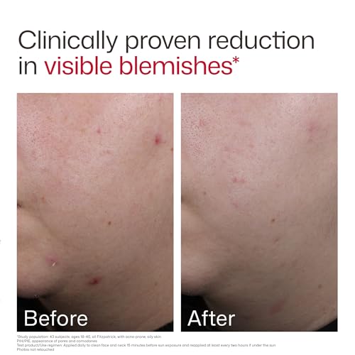 EltaMD UV Clear Blemish-Prone & Oil Balancing SPF 50, Non-Comedogenic Sunscreen with Zinc Oxide, Dermatologist Recommended