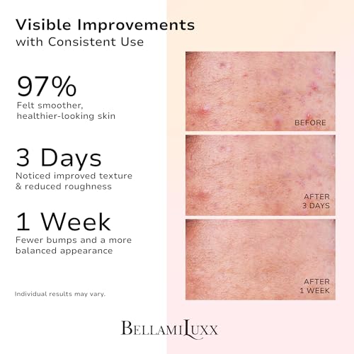 BellamiLuxx Butt Acne Treatment Set: Acne Soap Bar + Butt Treatment Lotion for Breakouts on Buttocks, Thighs, Back, Chest & Ingrown-Prone & Folliculitis-Prone Skin ? Helps Reduce Body Breakouts