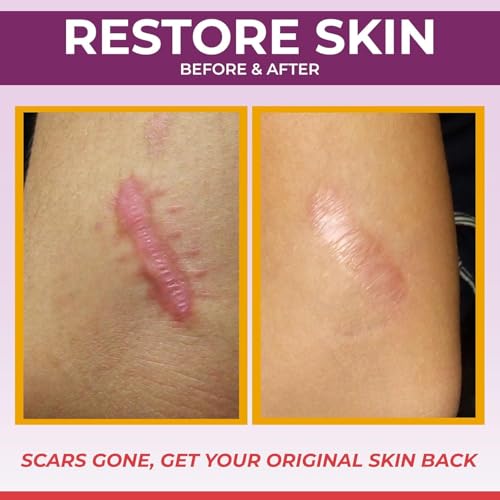Healqu Medical Grade Silicone Scar Sheets - 1 Pack, 1.6x120in, Non-Irritating & Pain-Free for Surgical and Keloid Scars