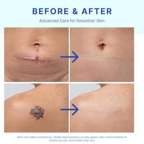 Suquato Silicone Scar Stick – Advanced Scar Treatment for Face & Body