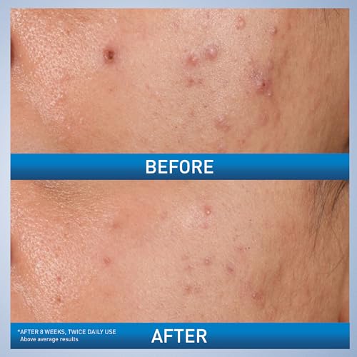 CeraVe Acne Control Gel with Salicylic & Glycolic Acid - 1.35oz