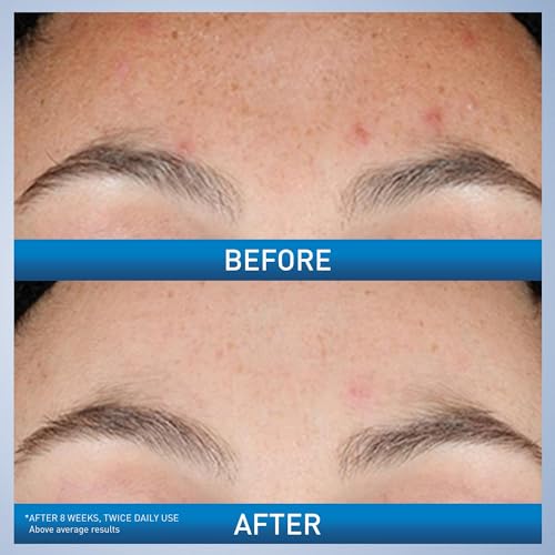 CeraVe Resurfacing Retinol Serum For Post Acne Marks, Formulated With Licorice Root Extract & Niacinamide, Brightening Serum & Pore Minimizer For Face, Post Acne Skin Barrier Repair, Non-Comedogenic
