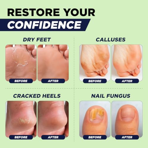 FOOT CURE Tea Tree Oil Epsom Salt Foot Soak, 16 Ounce - Callus & Odor Relief