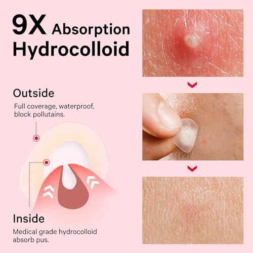 Sosky Invisible Hydrocolloid Acne Patches with Salicylic Acid - 96 Count