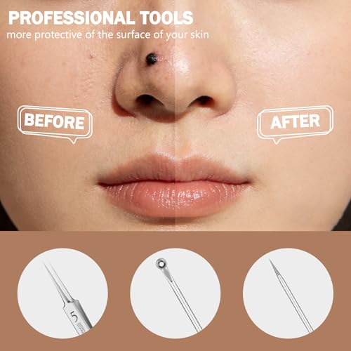 15-Piece Blackhead Remover Tool Kit - Stainless Steel Pimple Extractor