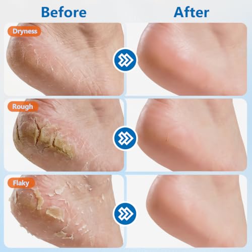 Urea Foot Cream Stick 60% Urea Moisturizer for Dry Cracked Heels & Skin