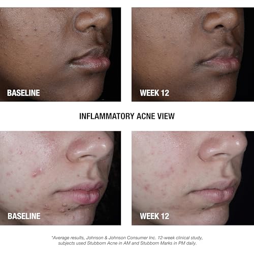Neutrogena Stubborn Acne AM Treatment with 2.5% Benzoyl Peroxide - 2 oz