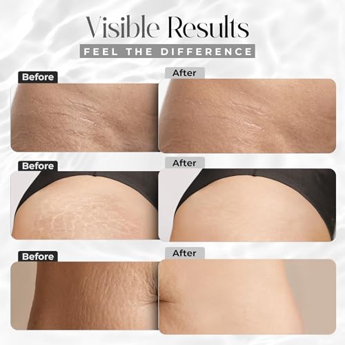 StretchMarkers Therapy Stretch Mark Cream ? Visibly Reduces and Treats, Stretch Marks Removal with Retinol, Hyaluronic Acid, Bioactive Peptides & 3D Stem Cell Technology, 1 fl oz