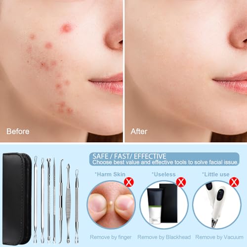 Teenitor 7-in-1 Pimple Popper Tool Kit - Blackhead & Acne Remover