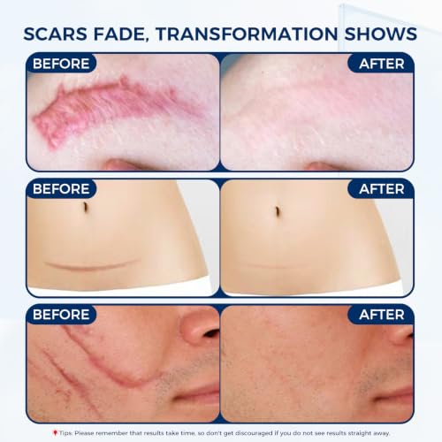 OUKEYA Silicone Scar Gel 30ml - Dermatologically Tested Scar Treatment for All Skin Types