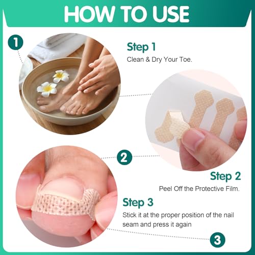 Ingrown Toenail Treatment Strips - 60 Count Breathable Toenail Corrector