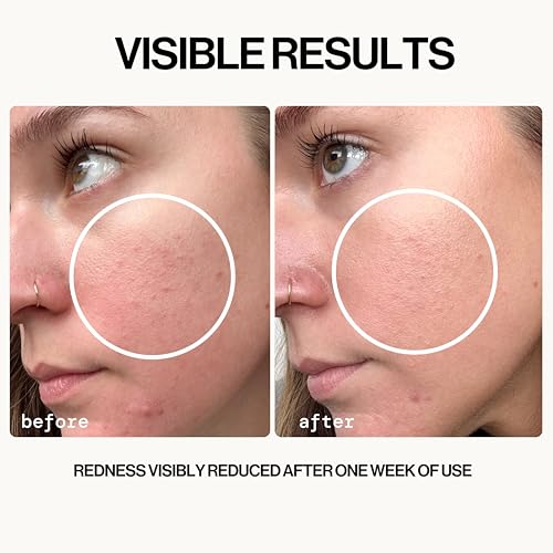 Pacifica Hypochlorous Acid Spray for Redness & Acne Relief