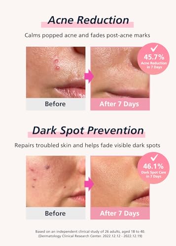 EasyDerm Real Calming Microdart Pimple Patches - 18 Count Dark Spot Care