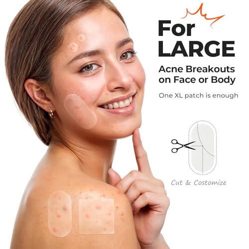 TKTK Hydrocolloid Pimple Patches, 124 Count XL Acne Strips (Pack of 2)