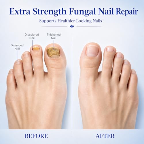 Toenail Fungus Treatment Pen: Extra Strength 25% Undecylenic Acid & Tea Tree Oil - Fungal Nail Treatment for Thick Yellow Brittle Toenails and Fingernails, 4 PCS
