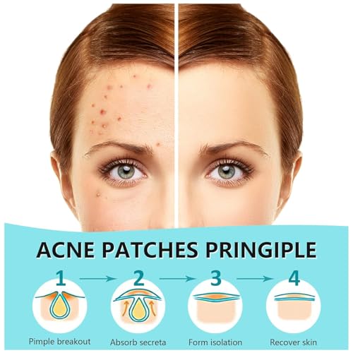 720 Count Hydrocolloid Acne Patches for Fast Pimple Healing