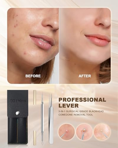 SGNEKOO Titanium Gold Facial Milia Removal Tool & Whitehead Extractor Kit