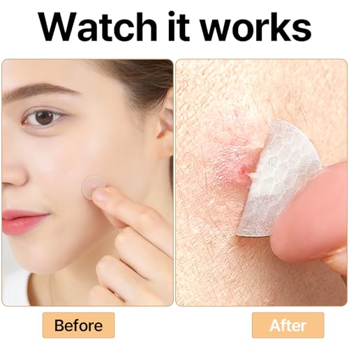 bonimooi Hydrocolloid Pimple Patches - 120 Count Invisible Acne Stickers