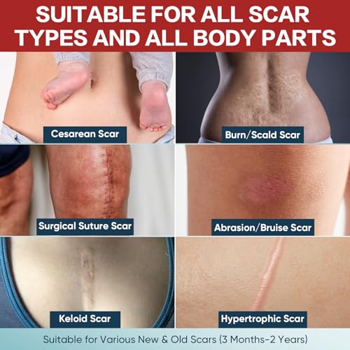 Silicone Scar Tape Roll 1.6x240 Inches for Scar Removal & Keloid Treatment