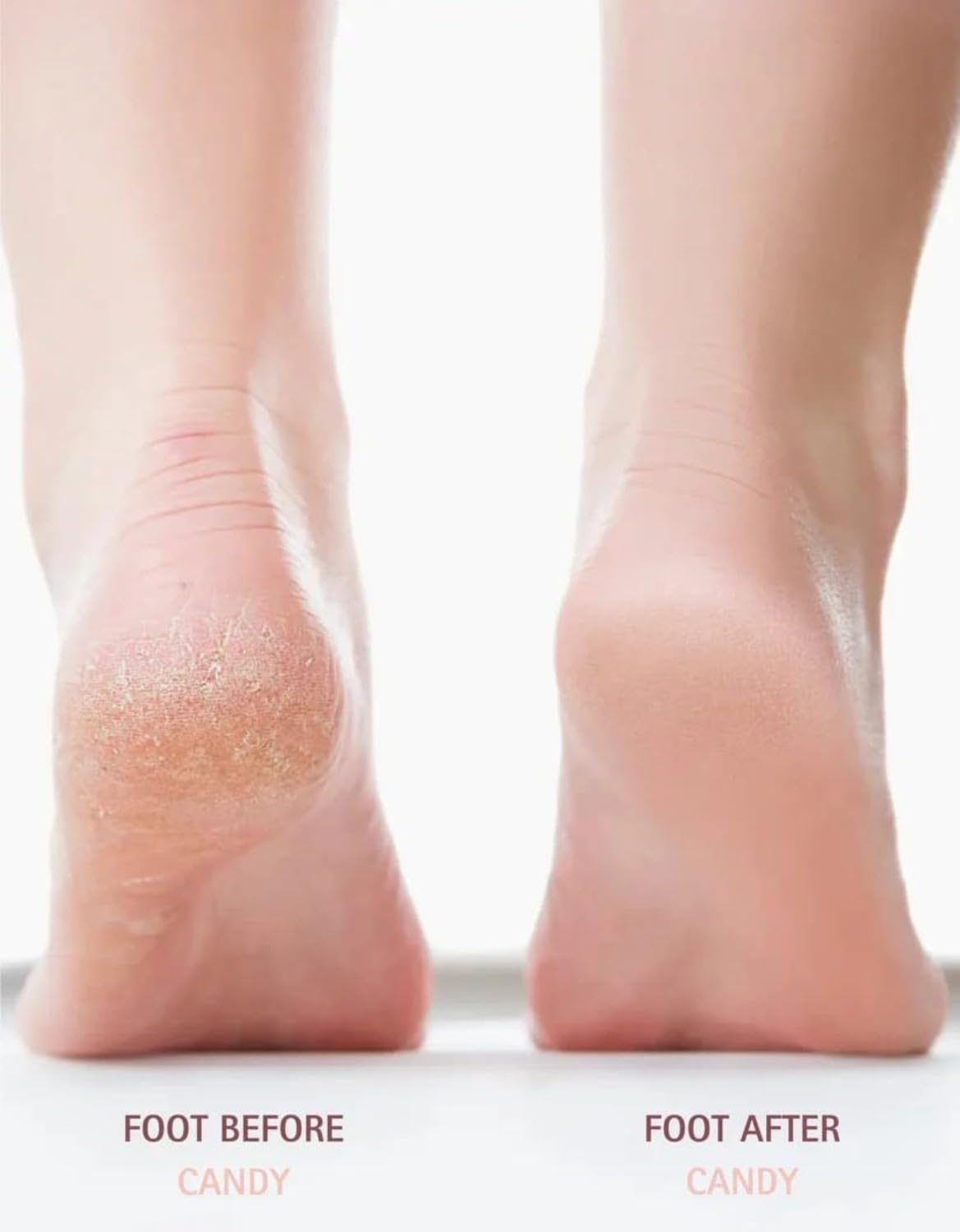 Nuve Callus Remover - Professional Silk 3 Pro Foot Care Tool | Effective & Gentle (White)