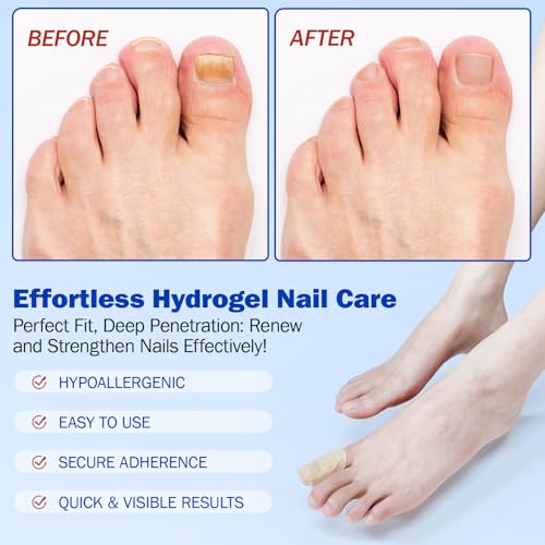 Flasture Overnight Nail Repair Patches - 21 PCS Hydrogel Toenail Treatment