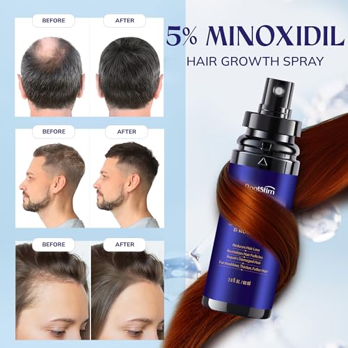 RootStim 5% Minoxidil Hair Growth Spray with Rosemary & Biotin - 2 Fl Oz