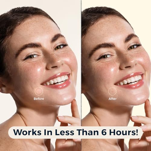 Havenique Hydrocolloid Acne Patches - 324 Count Pimple Spot Treatment