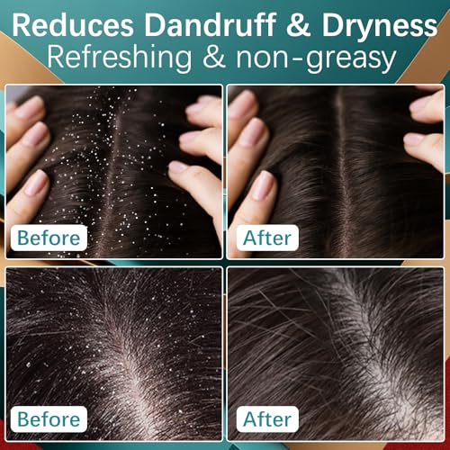 MQN 5% Minoxidil Hair Growth Scalp Cream with Biotin for Hair Loss