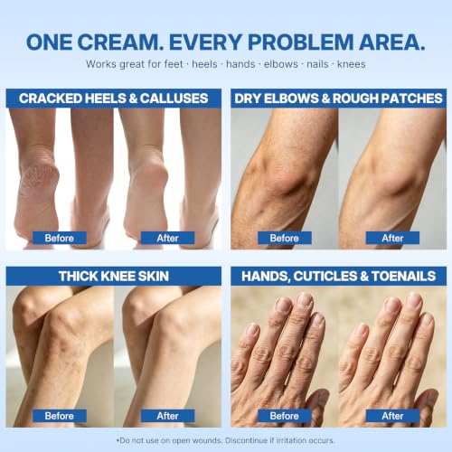 Maximum Strength Urea Cream 40% with Salicylic Acid 2% - Deep Hydration for Feet, Hands, Elbows & Knees
