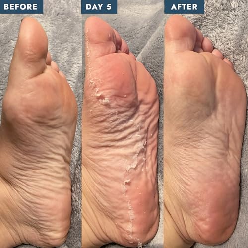 VOESH 1 Pack Exfoliating Peeling Socks for Dry & Calloused Feet - Home Spa Treatment