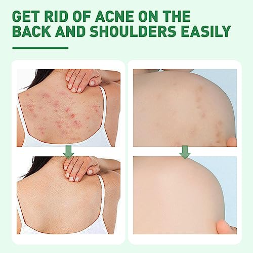 BEFIVECOK 2PCS Back Acne Spray Treatment with Herbal Formula, Salicylic Acid & Tea Tree Oil