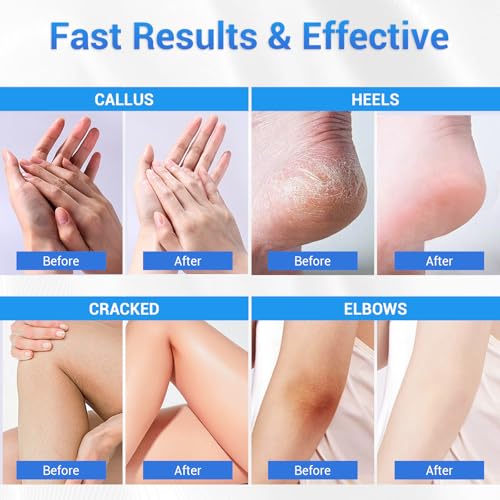 Sagry 40% Urea Cream for Feet & Hands - Deep Moisturizing Repair