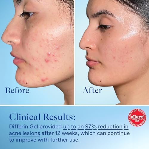Differin Acne Treatment Gel, 90 Day Supply, Retinoid Treatment for Face with 0.1% Adapalene, Gentle Skin Care for Acne Prone Sensitive Skin, 45g Pump (Packaging May Vary)