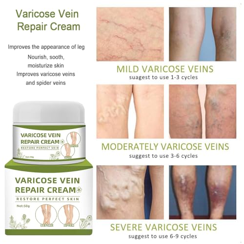 Varicose Veins Repair Cream - Leg Spider Vein Treatment Treatment 50g