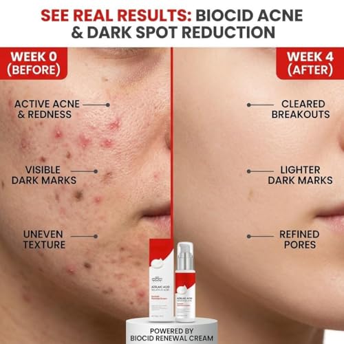 Yeardera 10% Azelaic Acid Acne Spot Treatment Cream - Soothing Moisturizer for Sensitive Skin, 1.6 oz