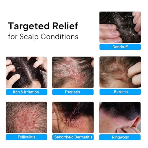 ProBliva Psoriasis Scalp Spray ? Scalp Treatment for Psoriasis, Dandruff & Seborrheic Dermatitis ? On-Demand Itch Relief ? Helps Reduce Flaking & Dryness ? Lightweight & Non-Greasy (4 fl oz)