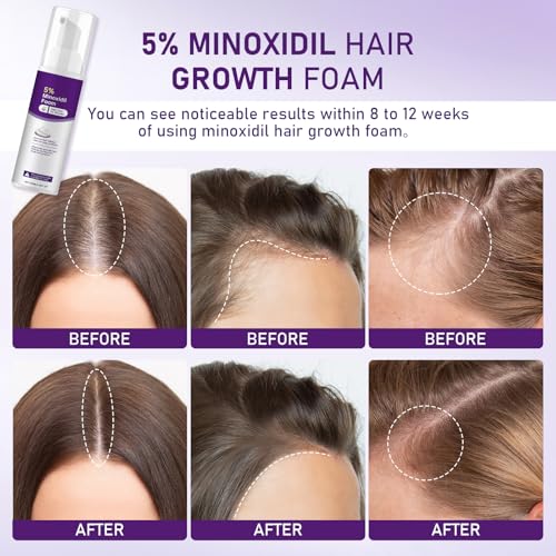 Fugit 5% Minoxidil Foam for Women Hair Growth - Thicker, Fuller Hair, 2 Bottles