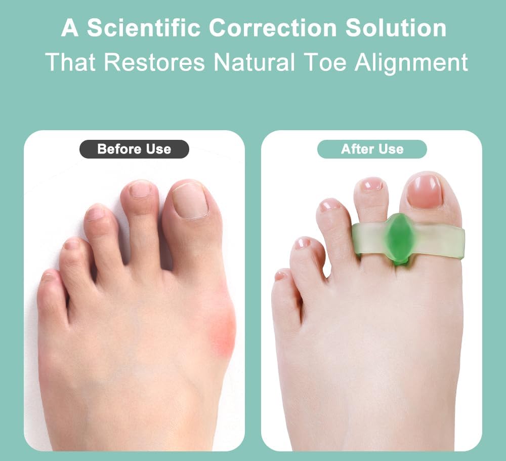Gel Toe Spacers - 8 Pcs Bunion Corrector & Hammer Toe Separator | Big Toe Straightener for Yoga (Green)
