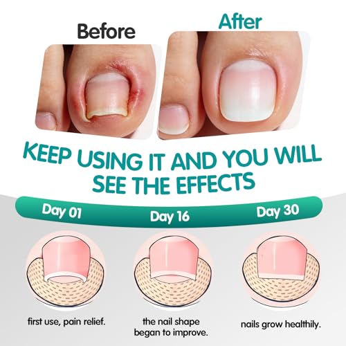 Ingrown Toenail Treatment Strips - 60 Count Breathable Toenail Corrector