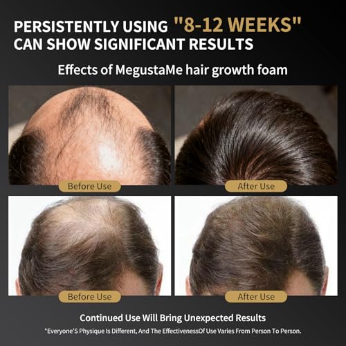 Men's Hair Growth Foam for Thinning Receding Hairline & Hair Loss - 60ml MegustaMe