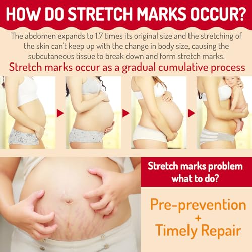 Stretch Mark Lotion for Pregnancy - 10.1 Fl Oz Body Care